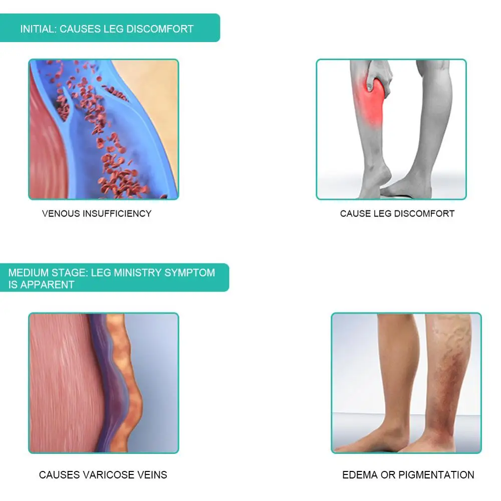 1 زوج جورب ضاغط طبي الجوارب 30 - مراجعة Compression Sock Medical وسعره